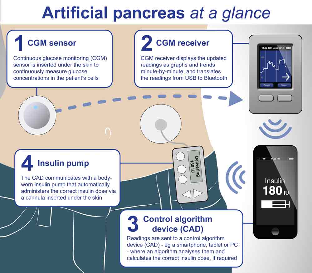 artificial-pancreas-2