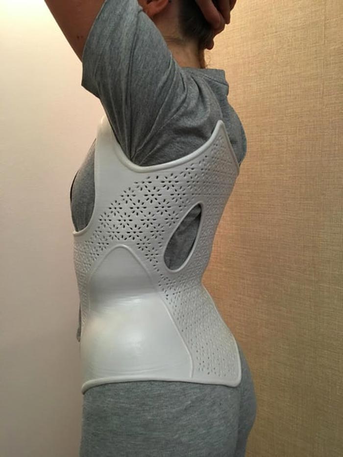 3d-printed-scoliosis-corset-3